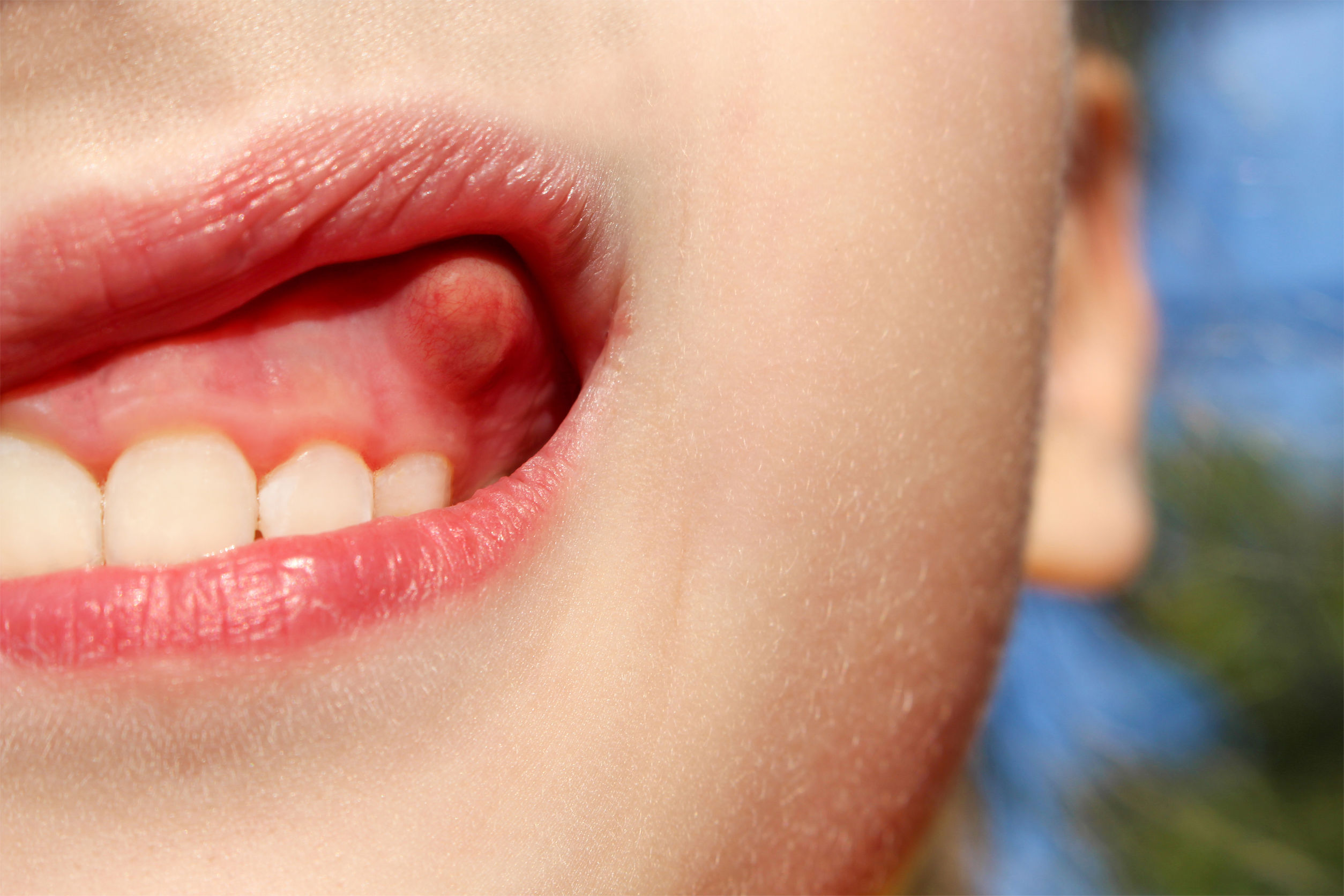 Home Remedies For Swollen Gums
